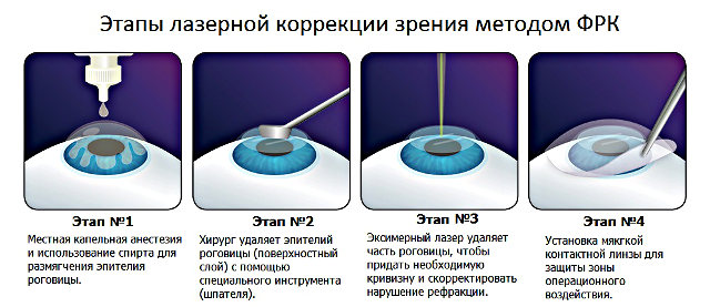 Лазерный витреолизис и коррекция зрения при деструкции стекловидного тела просто